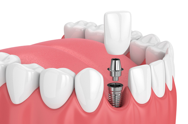 Rendering of jaw with dental implant in Hackettstown, NJ