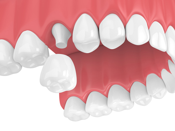 Rendering of jaw with dental crown in Hackettstown, NJ