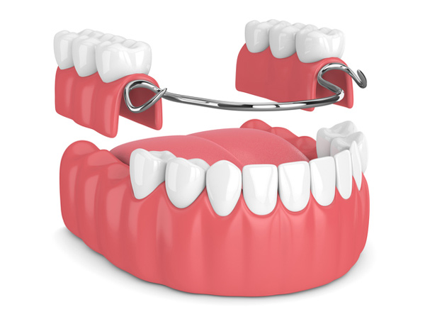 Rendering of removable partial denture in Hackettstown, NJ